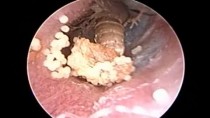 Microsuction Ear Cleaning : Living insect (Fly) & Her Eggs Removed from Ear Canal