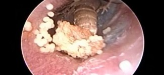 Microsuction Ear Cleaning : Living insect (Fly) & Her Eggs Removed from Ear Canal