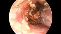 Ear Wax Removal by Microsuction after eardrop use
