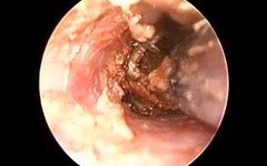 Ear Wax Removal by Microsuction after eardrop use