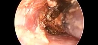 Ear Wax Removal by Microsuction after eardrop use