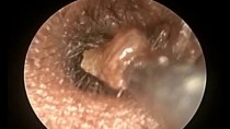 Otoendoscopic Both Ear Wax Removal First Time In small child by Microsuction & Probe