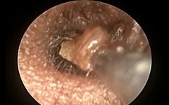 Otoendoscopic Both Ear Wax Removal First Time In small child by Microsuction & Probe