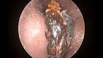 Oto-endoscopic Earwax Removal : Microsuction Earwax Cleaning