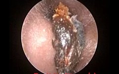 Oto-endoscopic Earwax Removal  : Microsuction Earwax Cleaning