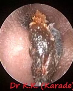Oto-endoscopic Earwax Removal : Microsuction Earwax Cleaning