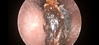 Oto-endoscopic Earwax Removal  : Microsuction Earwax Cleaning