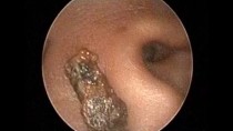 Soft Earwax Removal by Microsuction with the help of Otoendoscope