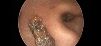 Soft Earwax Removal by Microsuction with the help of Otoendoscope