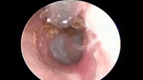 Oto-endoscopic Both Ear Wax Removal by Microsuction – Best Method for Ear Wax Removal