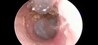 Oto-endoscopic Both Ear Wax Removal by Microsuction – Best Method for Ear Wax Removal