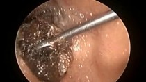 Microsuction Ear Wax Removal In small child & Probe endoscope