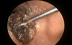 Microsuction Ear Wax Removal In small child & Probe endoscope