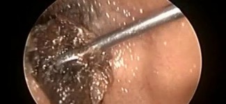 Microsuction Ear Wax Removal In small child & Probe endoscope